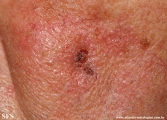 basal cell carcinoma