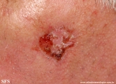 basal cell carcinoma