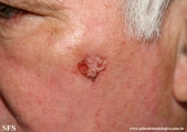 basal cell carcinoma