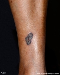 basal cell carcinoma