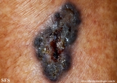 basal cell carcinoma