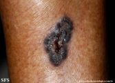 basal cell carcinoma