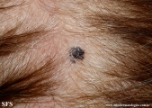 basal cell carcinoma