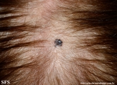 basal cell carcinoma