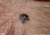 basal cell carcinoma