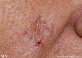 basal cell carcinoma