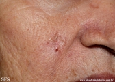 basal cell carcinoma