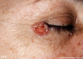 basal cell carcinoma