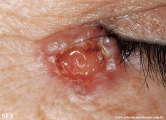 basal cell carcinoma