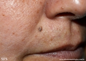 basal cell carcinoma