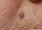 basal cell carcinoma