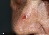 basal cell carcinoma