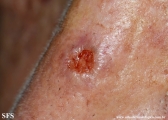 basal cell carcinoma