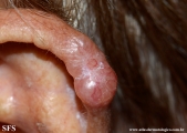 basal cell carcinoma