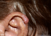 basal cell carcinoma