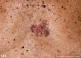 basal cell carcinoma