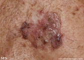 basal cell carcinoma