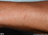 basal cell carcinoma