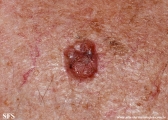 basal cell carcinoma
