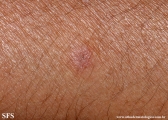 basal cell carcinoma