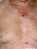 basal cell carcinoma
