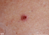 basal cell carcinoma