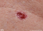 basal cell carcinoma