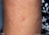 basal cell carcinoma