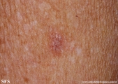 basal cell carcinoma