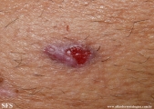 basal cell carcinoma
