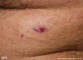 basal cell carcinoma
