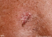 basal cell carcinoma