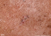 basal cell carcinoma