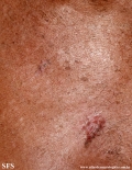 basal cell carcinoma