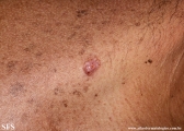 basal cell carcinoma