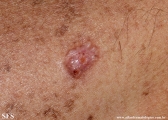 basal cell carcinoma