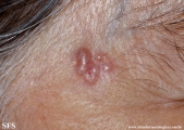 basal cell carcinoma