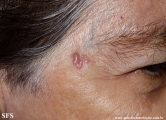 basal cell carcinoma