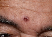 basal cell carcinoma