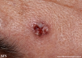 basal cell carcinoma