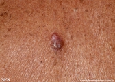 basal cell carcinoma