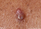 basal cell carcinoma