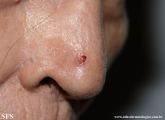 basal cell carcinoma