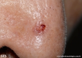 basal cell carcinoma