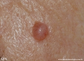 basal cell carcinoma