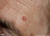 basal cell carcinoma