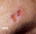 basal cell carcinoma