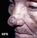 basal cell carcinoma