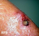 basal cell carcinoma