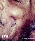 basal cell carcinoma